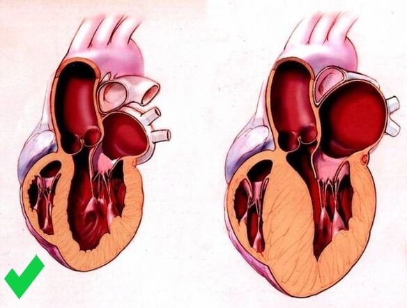 Cardione zapobiega przerostowi komór serca